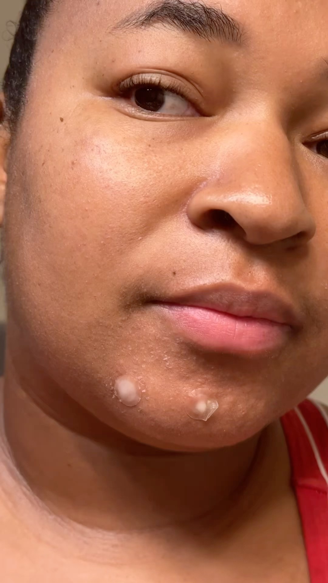 WHAT TO DO WHEN HAVING BAD BREAKOUTS Skincare Tips skincareroutine WHAT TO DO WHEN HAVING BAD BREAKOUTS Skincare Tips skincareroutine