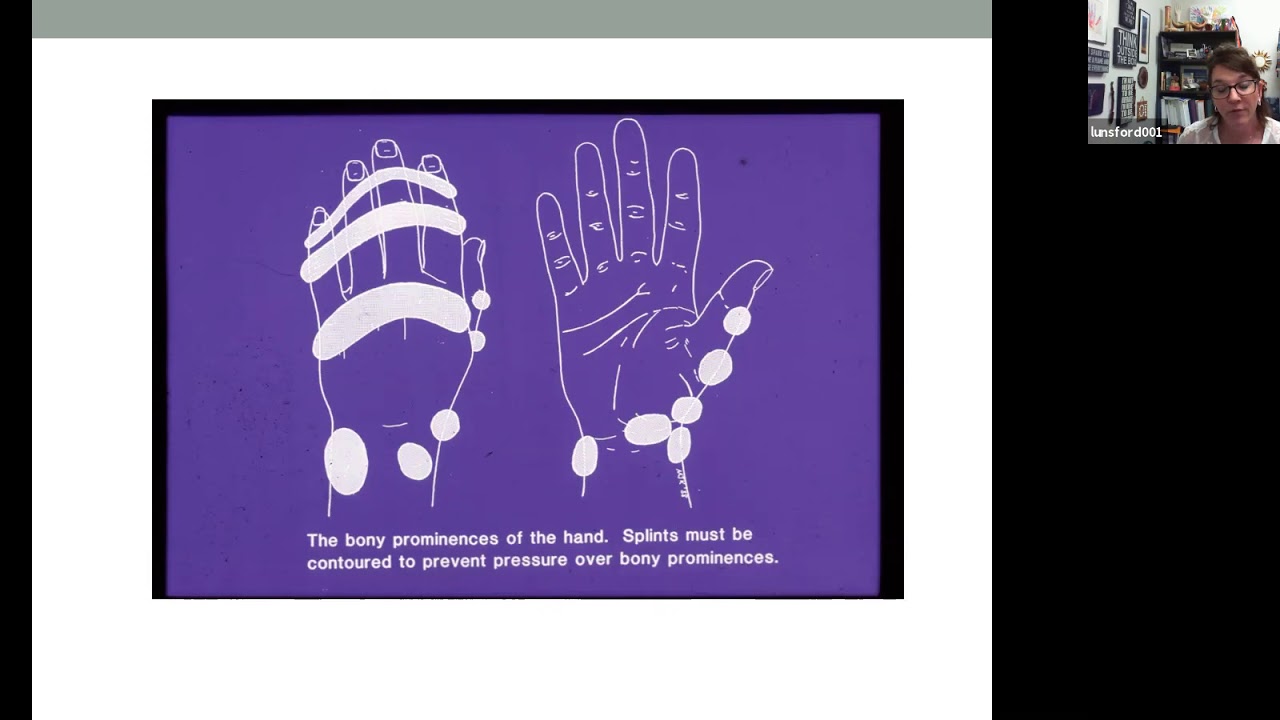 Splinting Webinar by OT ECHO Mentorship