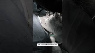 Graft Extraction From The Donor Area
