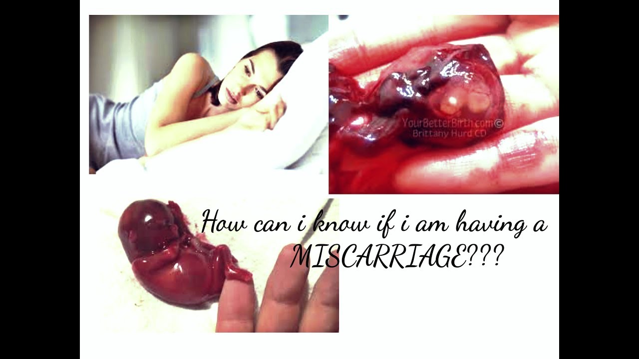 Miscarriage, also known as spontaneous abortion and pregnancy loss
