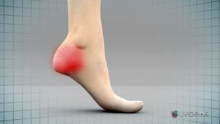 ¿Cómo curar el dolor del talon del pie?
