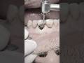 Root canal treatment & composite veneer for central incisor deep labial cavity #dentist #dental