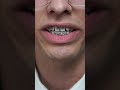 2 weeks with braces