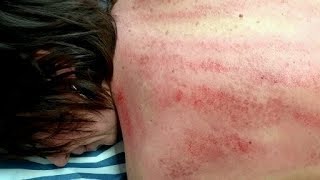 Гуаша.Массаж у владимира Гуаша.Массаж у владимира