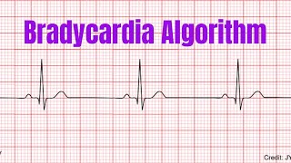 Bradycardia Algorithm