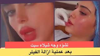 تشوه وجه شيلاء سبت وبكائها من الالم وهي تذيب الفيلر !! ملامحها تصدم الجمهور