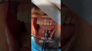 PLATFORM SWITCH MICROGROOVED 1-TIME ZIRCOPINGS FOR TTPHIL : 1-FIX 1-APPOINTMENT PROTOCOL #shorts