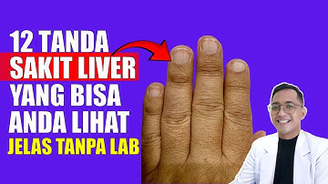 Tanda-Tanda Penyakit Liver (Hati) yang Terlihat dari Fisik Anda!