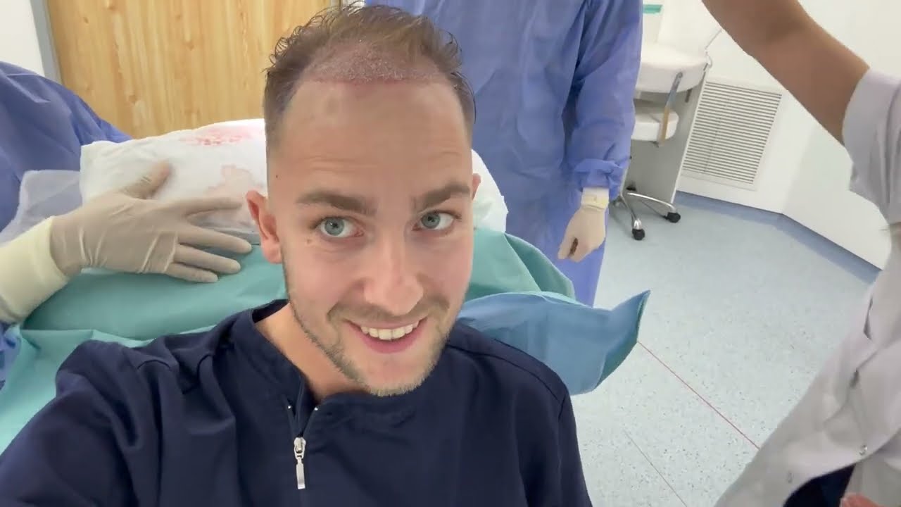 Deel 3 van Rick's DHI (ongeschoren) haartransplantatie