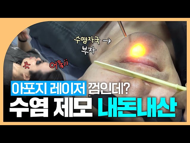 통증 탑티어 수염 레이저 제모 별로 안 아ㅍ...｜의사의 내돈내산 💸