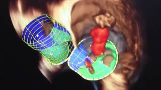 Structural Heart Procedure Navigation - ASE 2016 screenshot 1