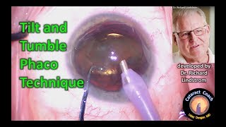 Tilt and Tumble Phaco Technique - for efficient and safe cataract surgery