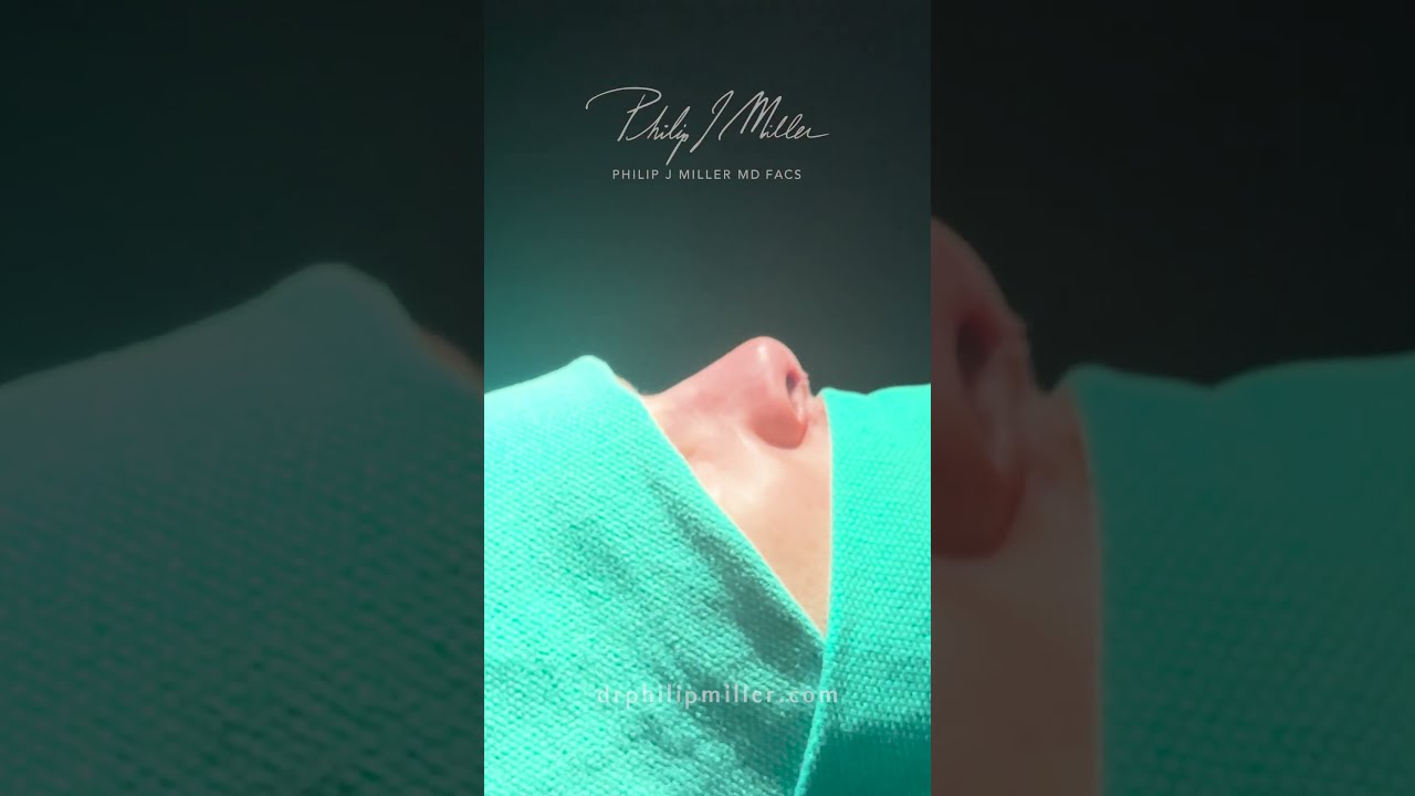 Immediate Rhinoplasty Post Op Results!