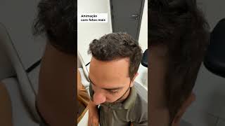 Implante Capilar em GV - Dr. Felipe Salmen