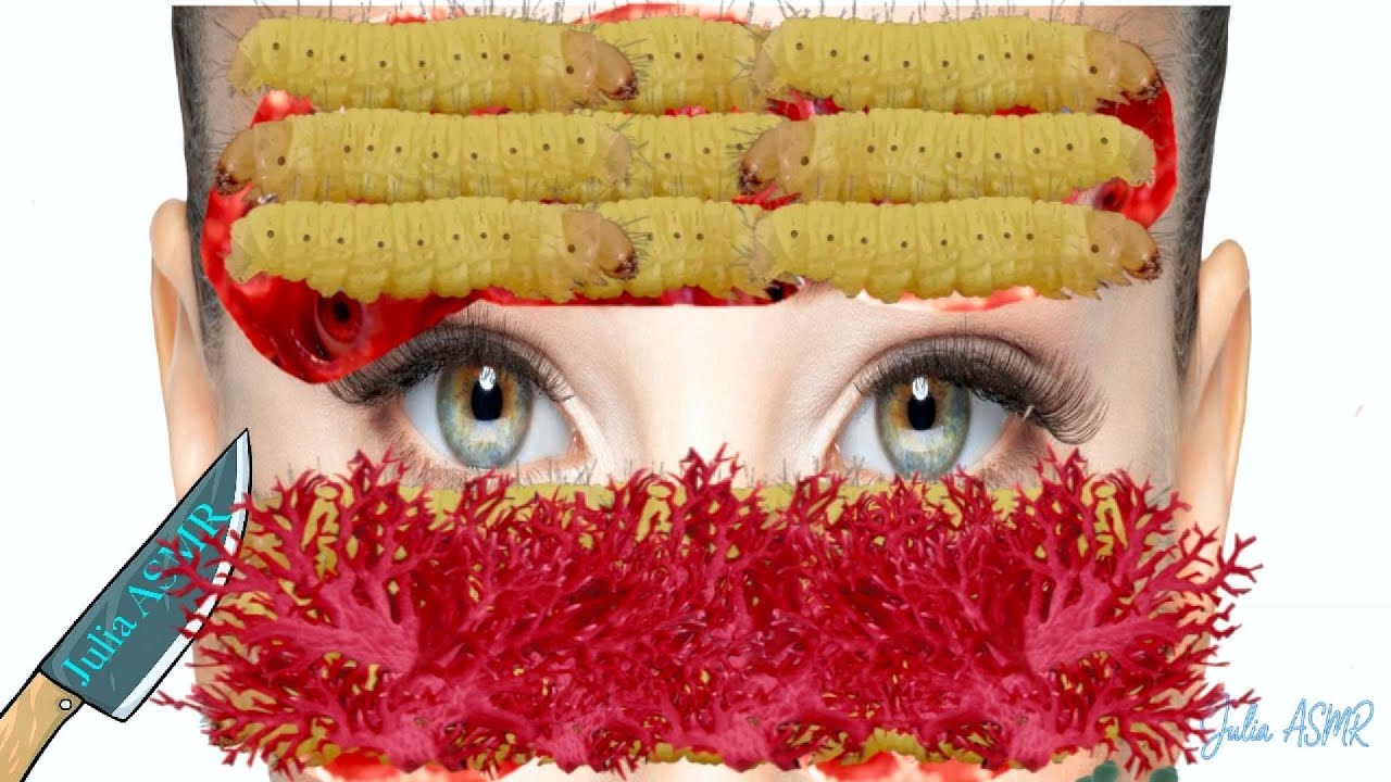 ASMR Remove  Maggots & Trypophobia from Infected Face | 2D Animation | Deep Cleaning Animation