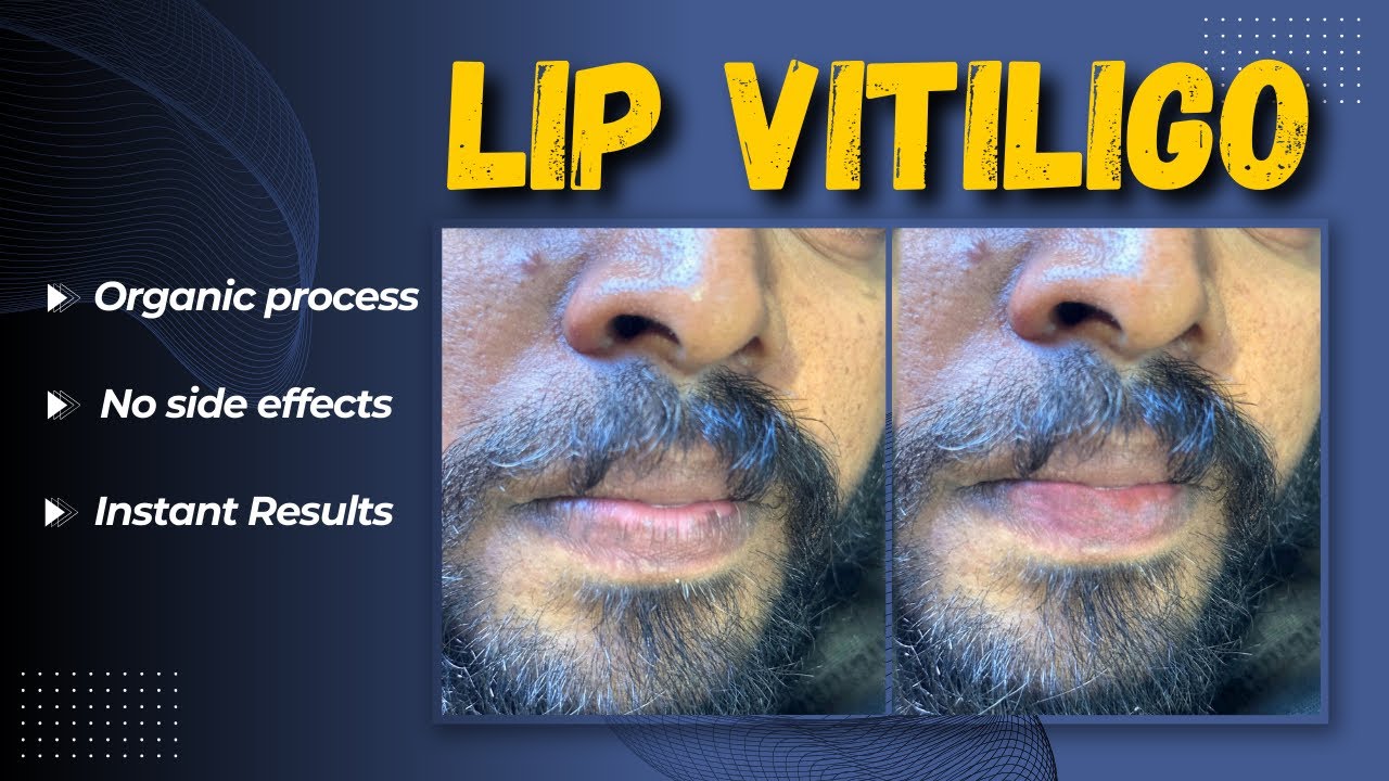 Vitiligo lips treatment Organic process Machu clinic YouTube