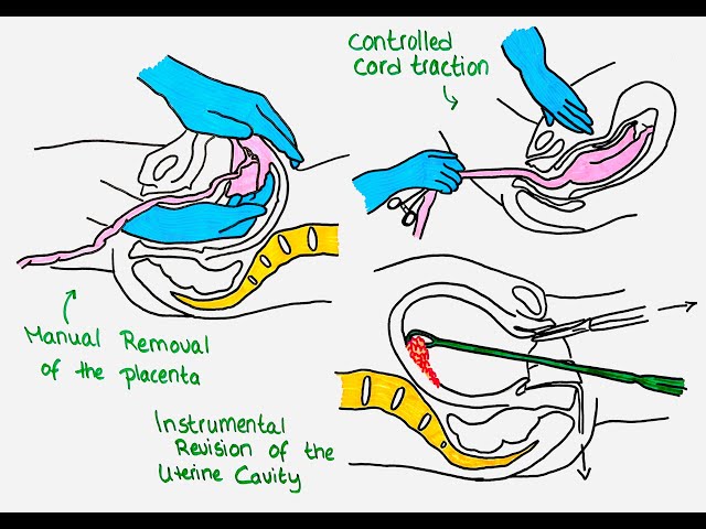 Manual Removal of Placenta and Uterine Cavity Revision