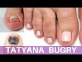 HUGE Transformation On Damaged Toenails | Pedicure Restoration w/ Poly Gel