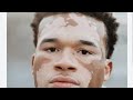 البهاق vitiligo الجزء  4