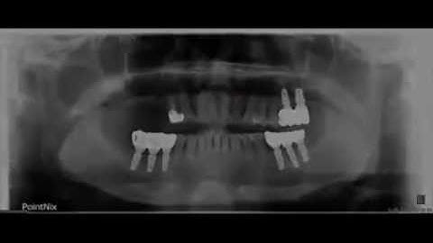 Simplified sinus augmentation using HPISE