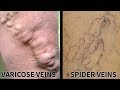 All about varicose veins | Usapang Pangkalusugan