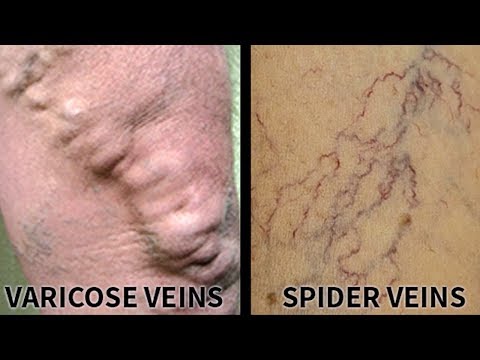 All about varicose veins | Usapang Pangkalusugan