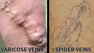 All About Varicose Veins Usapang Pangkalusugan