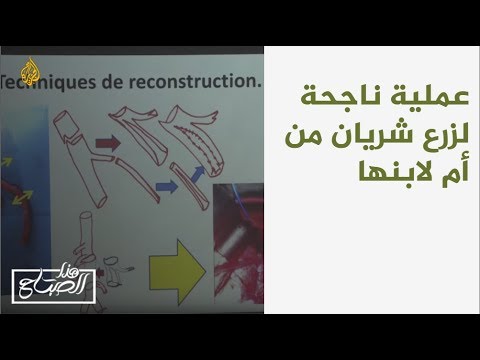 هذا الصباح - عملية ناجحة لزرع شريان من أم لابنها