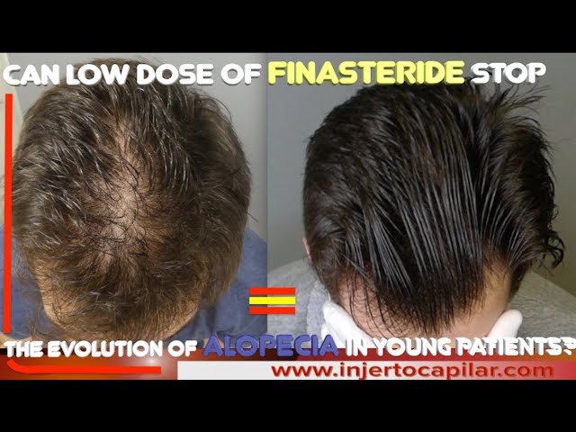 Finasteride En España