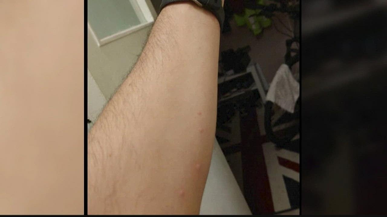 White House declares public health emergency over monkeypox outbreak