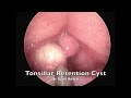 Tonsillar retention cyst  incision and drainage  dr sunil kewat