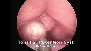 Tonsillar Retention Cyst | Incision and Drainage | Dr Sunil Kewat Cyst Of Tonsil