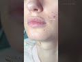 #lipfiller @Dra.Sherina #shorts # #love #botulinumtoxin #rellenodelabios sexydrop