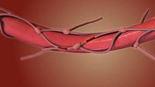 Esophagectomy. Esophagus Removal Animation by Drugs.com 90,516 views 6 years ago 34 seconds