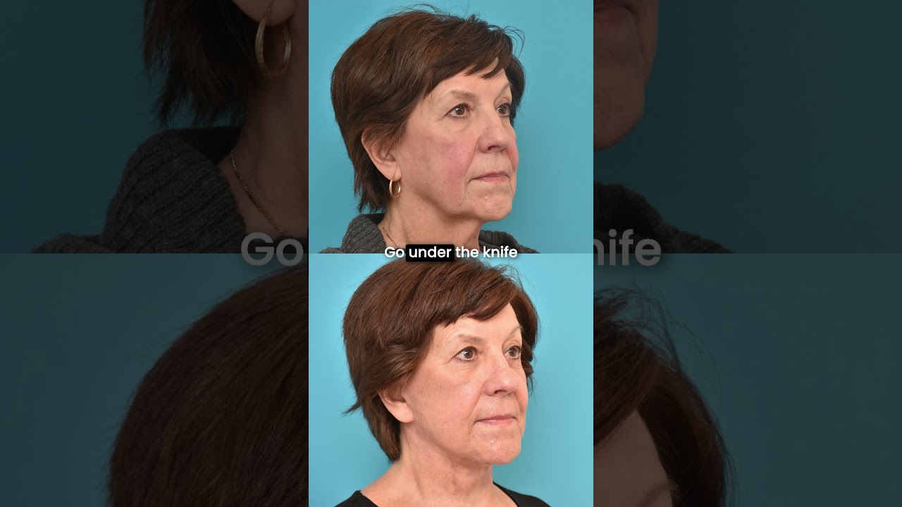Facelift & Skin Laxity | Why Surgery Is the Only Way for Maximum Results ✨