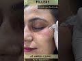 Woman With Dark Circles Get Under-Eye Filler Injections For The First Time | AwishClinic.com #shorts