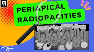 Periapical lesions | Periapical radiopacities | Oral radiology| Apical radiopacities