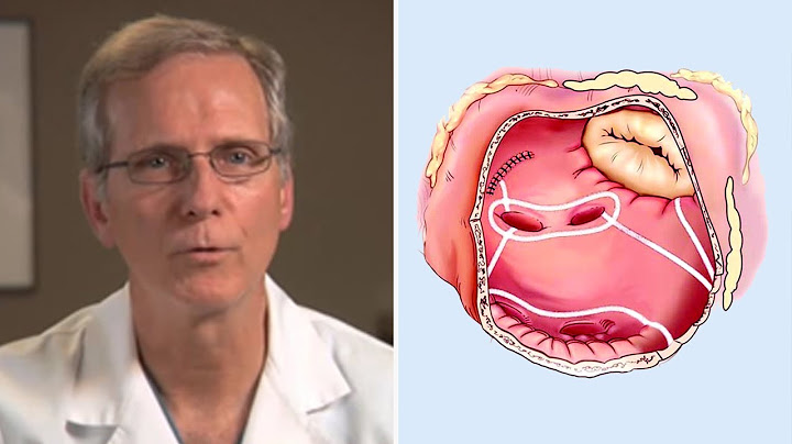 Treatment of atrial fibrillation after aortic valve replacement