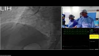 Live CTO Case  by Dr A Sharath Reddy  | Interventional Cardiology screenshot 5