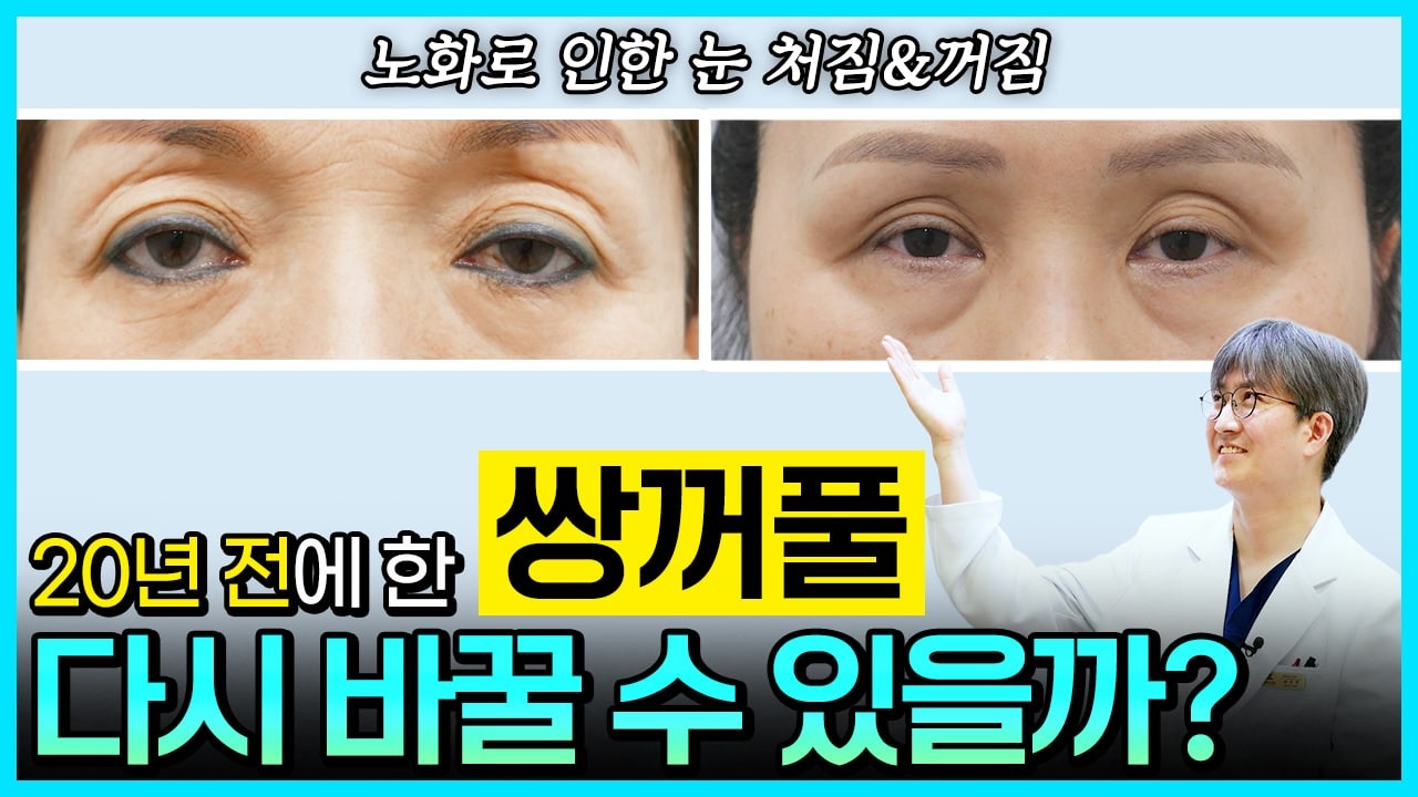#눈성형 #눈수술 #쌍수 #쌍꺼풀수술 #상안검 #눈썹밑거상 #이마거상 #눈위지방재배치 #눈매교정 #지방이식 #비절개 #절개 #하기영 #제이준성형외과피부과