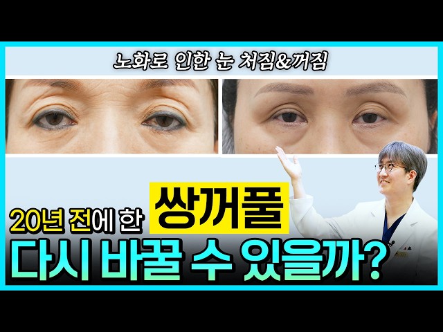20년 후 변해버린 쌍꺼풀... 다시 바꿀 수 있을까요?