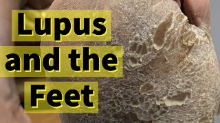 Lupus and the Feet: Severe Calluses and Dry Skin