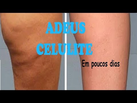 Cafe Com Azeite Para Celulite Funciona Elimine A Celulite Em Poucos Dias Receita Facil E Rapida Youtube
