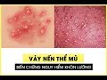Bệnh vảy nến thể mủ l&agrave; g&igrave;? Bệnh nguy hiểm như thế n&agrave;o
