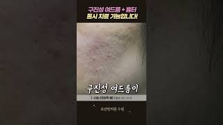 여드름흉터 치료 중 여드름이 생긴다면? 한번에 해결하는 방법!