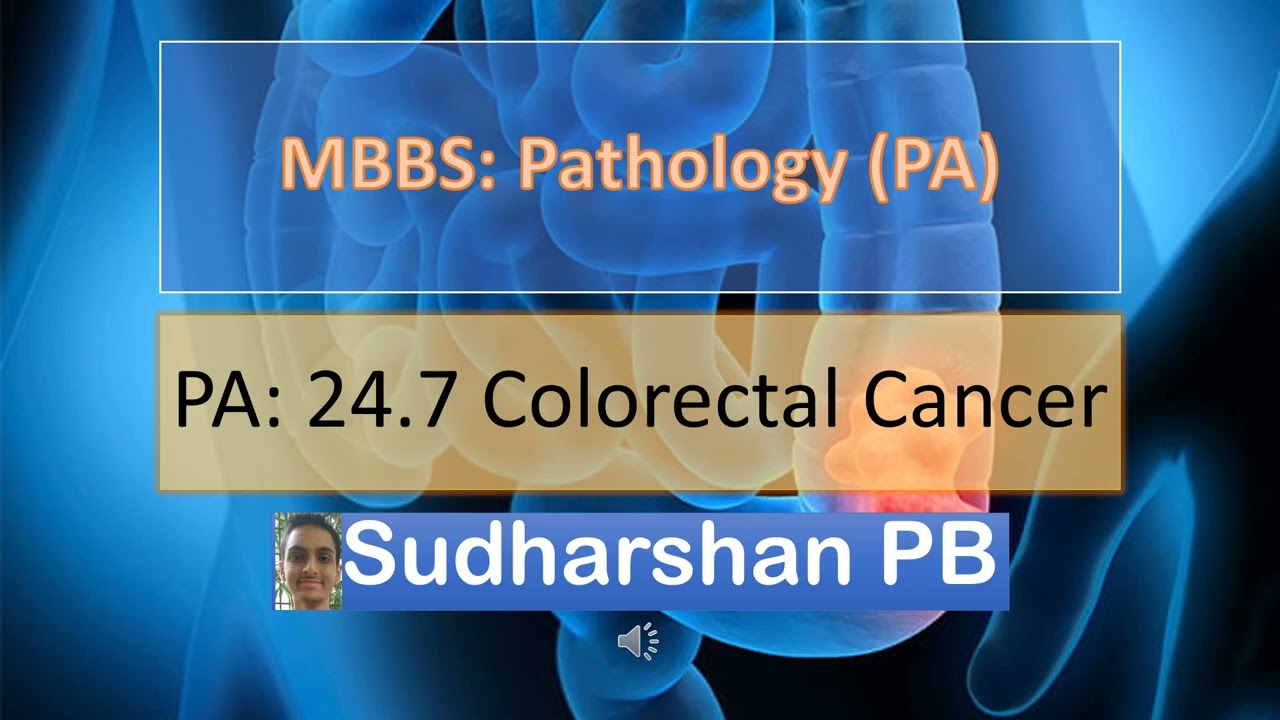 MBBS PA 24.7 Colorectal Cancer| Sudharshan PB