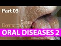 Dermatological cases of oral diseases 2