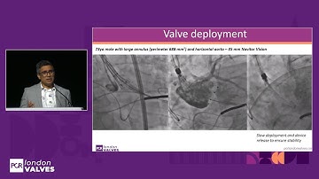How to optimise TAVI outcomes in extreme patient anatomies?
