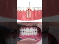 Root Canal Treatment in Turkey 🇹🇷 | Step-by-Step Process & Results