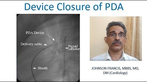 Device Closure of Patent Ductus Arteriosus PDA